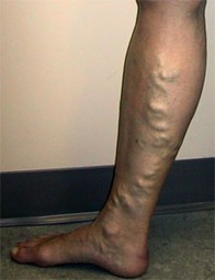 varices C2 varices C2